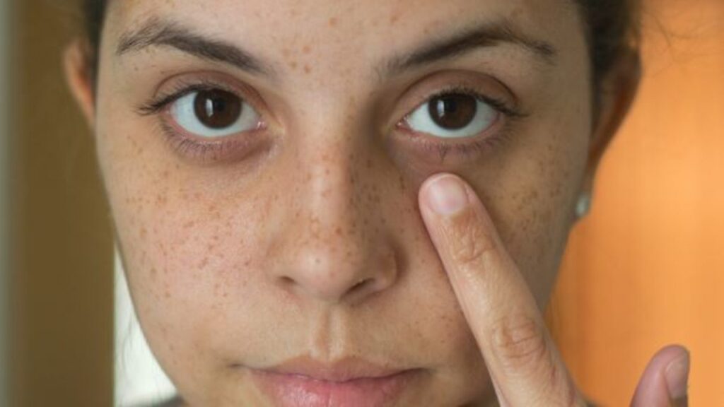Dark circles